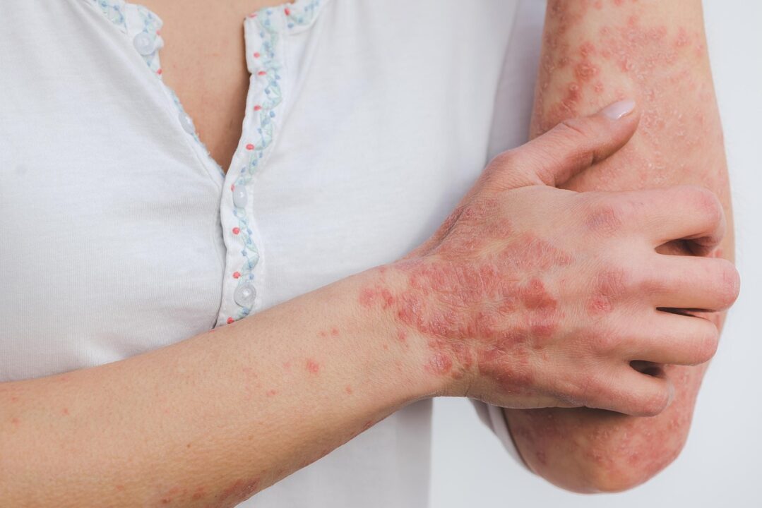 miller eszter psoriasis