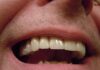 johnoaz teeth