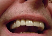 johnoaz teeth