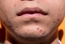yiyiphotos acne