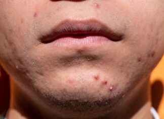 yiyiphotos acne
