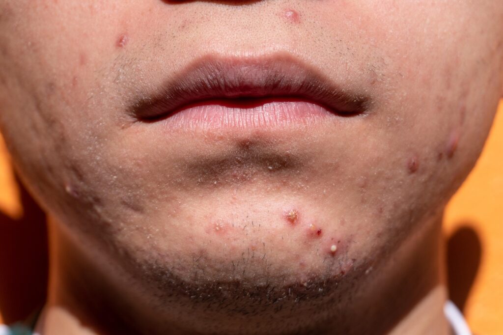 yiyiphotos acne